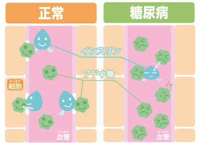 糖尿病