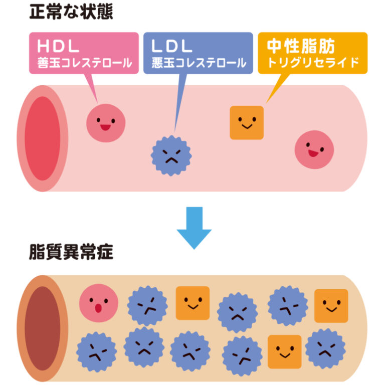 脂質異常症