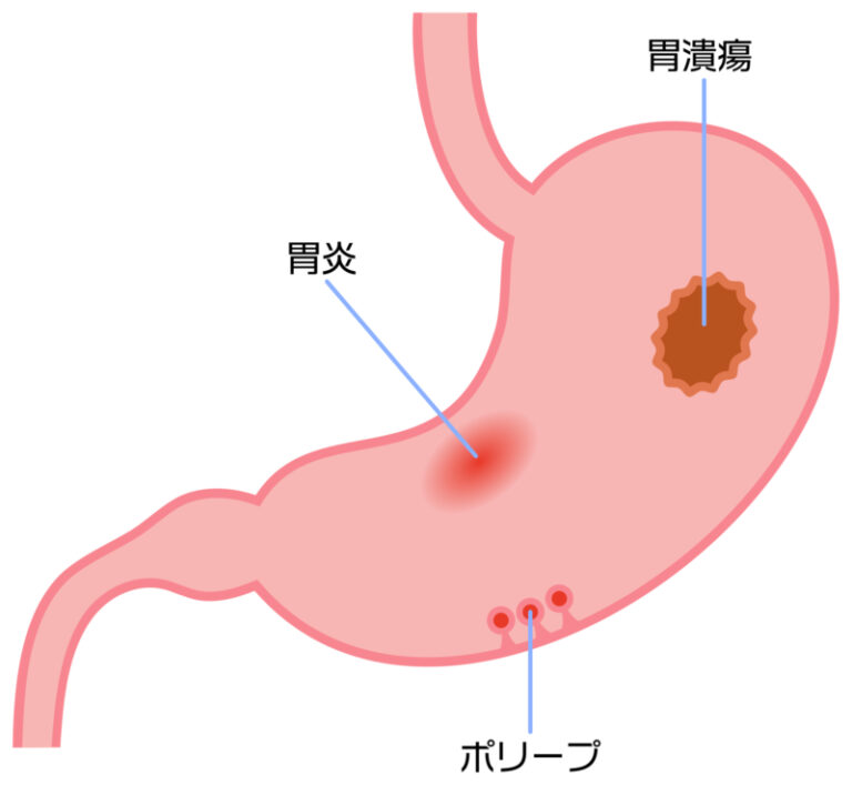 胃炎